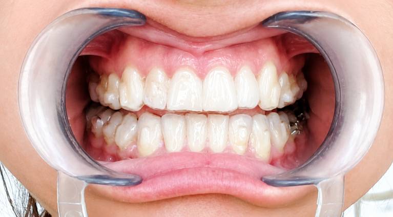 allineamenti dentali.png